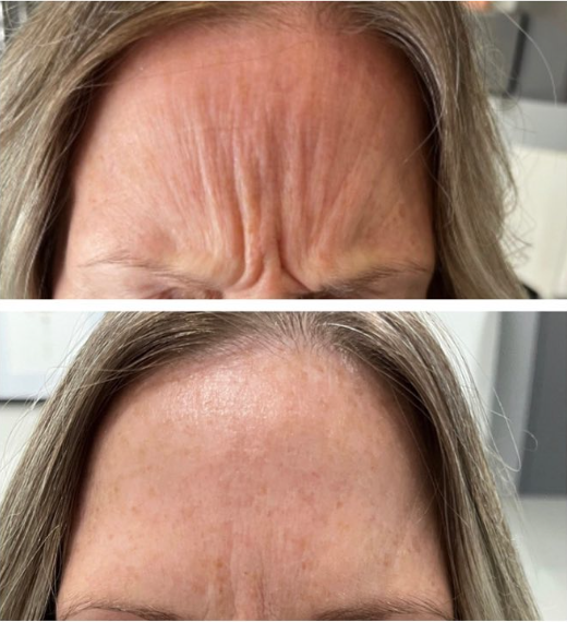 Botox Treatment in Regina for Wrinkle Reduction