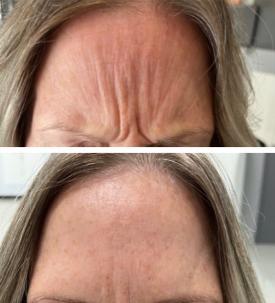 Botox Treatment in Regina for Wrinkle Reduction