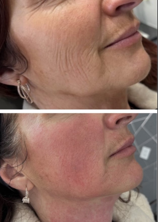 Morpheus8 Treatment for Facelift in Regina vs. Traditional Facelift: Which is Right for You? 