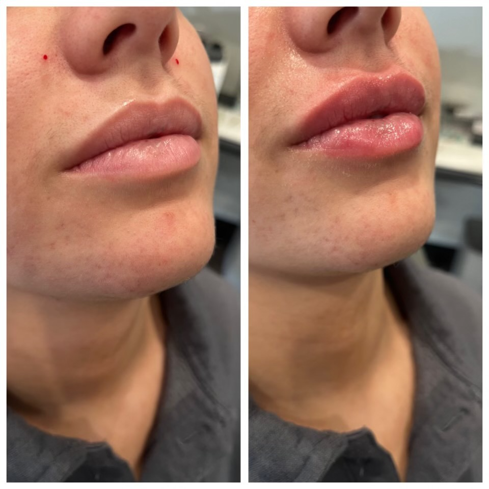 Lip Fillers Treatment in Regina for Volume, Enhancement & Natural Definition  