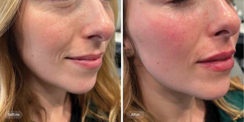 What is the Best Wrinkle Reduction Treatment in Regina - Botox or Dermal Fillers?